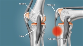 Morbus Osgood Schlatter